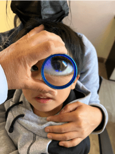 Niño en consulta oftalmológica con lupa en el ojo, en revisión visual.